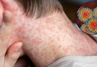 Küresel Kızamık Salgını ve Aşılamanın Önemi