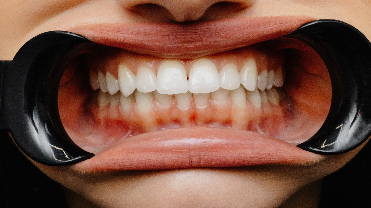 1. Solgun Diş Etleri: Kansızlık ve Demir Eksikliği