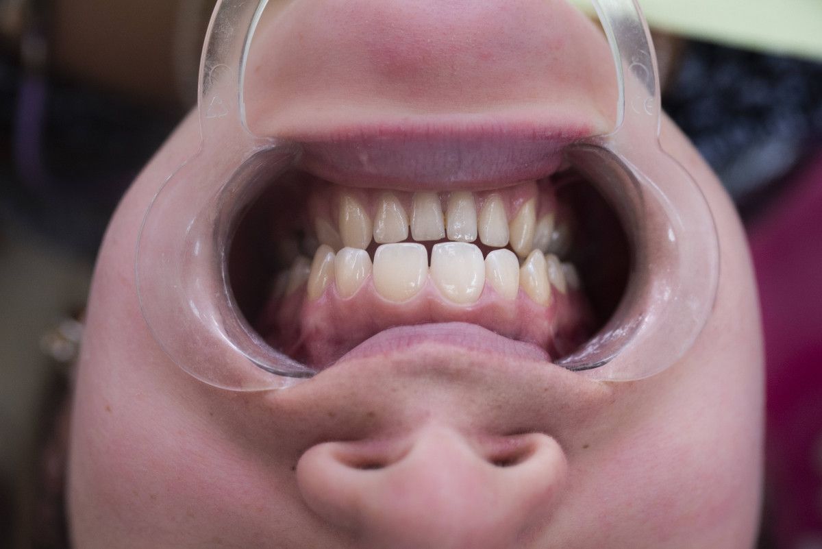 3. Mor ve Mavi Tonlarda Diş Etleri: Dolaşım Problemleri ve Oksijen Yetersizliği