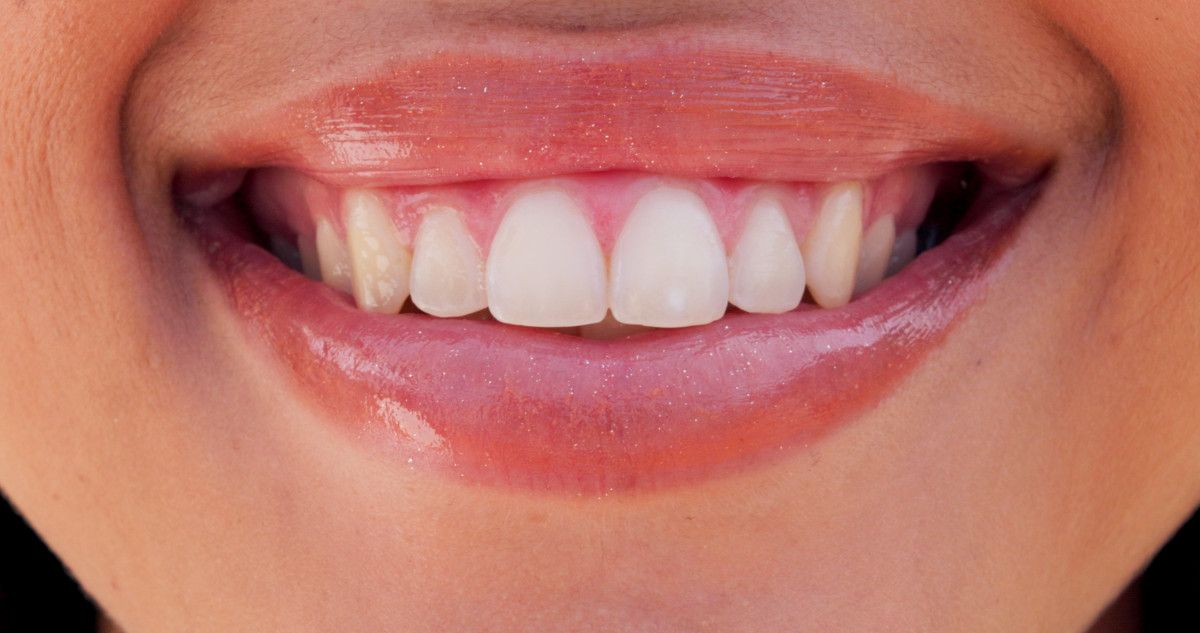 4. Kahverengi Diş Eti Renkleri: Melanin Birikimi veya Zehirlenme