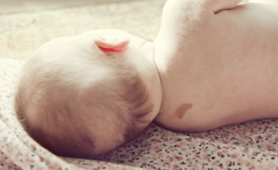 Doğum Lekeleri İki Ana Kategoriye Ayrılır: