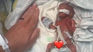 Doktorlar Yaşamaz Demişti! 280 Gram Doğan Bebekten Dünya Rekoru Kıran Başarı