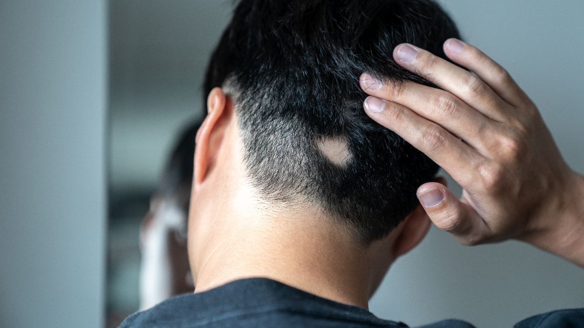 Erkeklerde Saçkıran ve Yoğun Stres Arasındaki Bağlantı