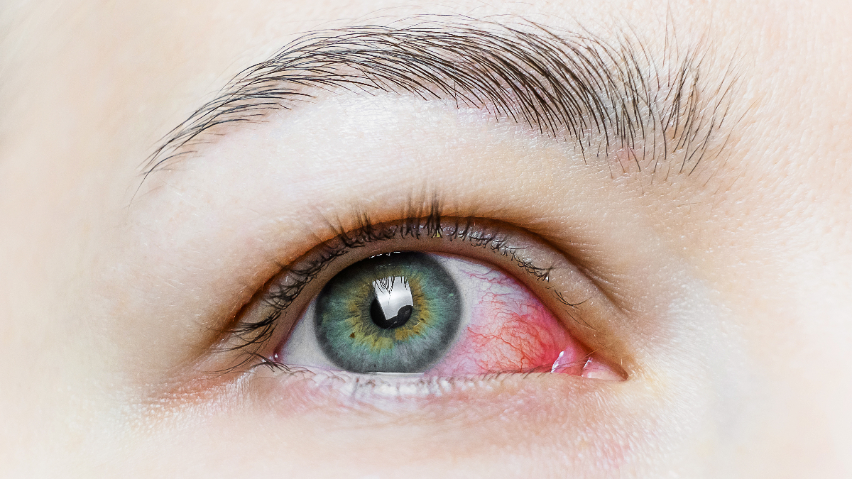 Gözünüzde Bu Belirtiler Varsa Sakın Hafife Almayın