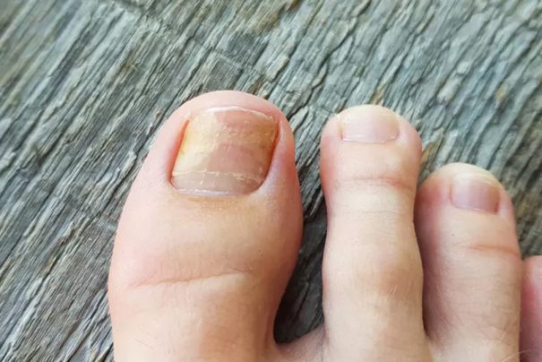 Tırnak Mantarı İçin Doğal Çözüm: Sadece 2 Malzeme ile Mantar Sorununu Ortadan Kaldırın