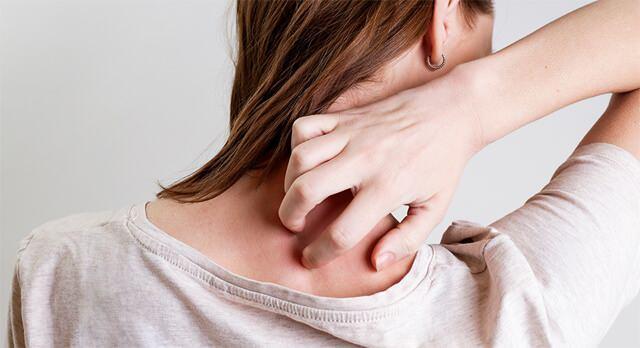 Alfa-Gal Sendromu ve Kene Isırığının Hayatınıza Etkileri: Süt ve Et Tüketiminde Dikkat!