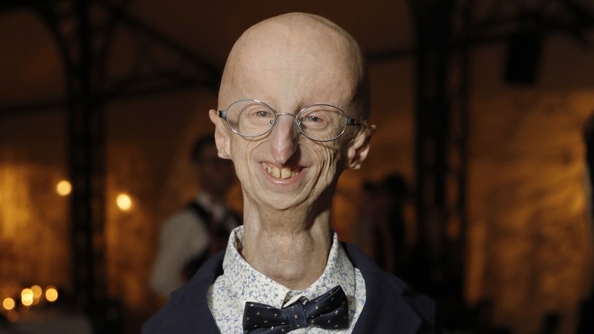 Çocuklarda Hızla Yaşlanma ve Ömür Kısalmasına Yol Açan Progeria Hastalığı