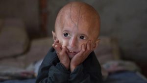 Çocuklarda Hızla Yaşlanma ve Ömür Kısalmasına Yol Açan Progeria Hastalığı