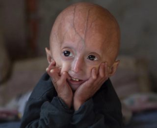 Çocuklarda Hızla Yaşlanma ve Ömür Kısalmasına Yol Açan Progeria Hastalığı