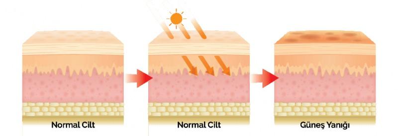 Güneşlenme Sonrası Cilt Bakımı ve Koruma Yöntemleri