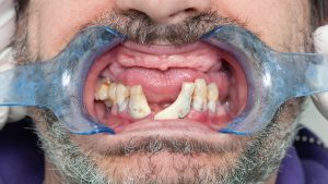 Kalp Rahatsızlıklarının Gizemli Nedeni: Diş Fırçalamamağın Gizli Rolü