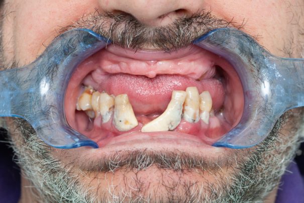 Kalp Rahatsızlıklarının Gizemli Nedeni: Diş Fırçalamamağın Gizli Rolü