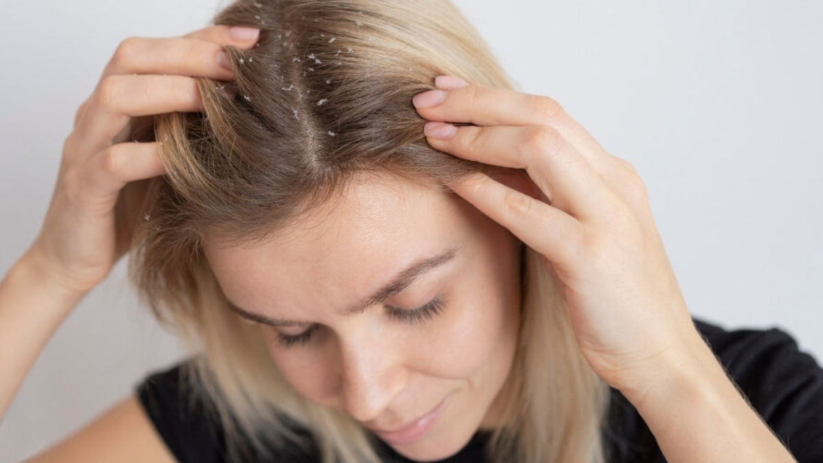 Saç Egzaması Nedenleri ve Tedavi Yöntemleri: Saçta Egzama Nasıl Geçer?