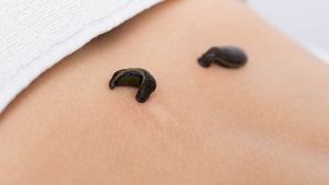 Sülük Tedavisinin Faydaları ve Etkinliği Hakkında Bilmeniz Gerekenler