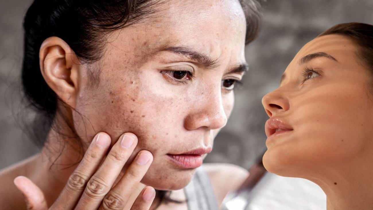Güneş Lekelerini Gidermede Doğal Yöntemler