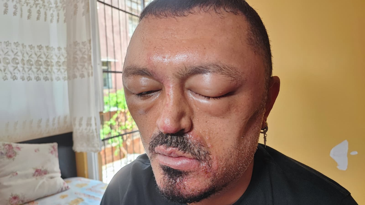 Saçlarını koyu renge dönüştürmek isteyen 48 yaşındaki Murat Gözde'nin başına gelmeyen kalmadı. İnternetten satın aldığı saç siyahlaştırıcı şampuan yüzünden ciddi sağlık sorunları yaşadı.