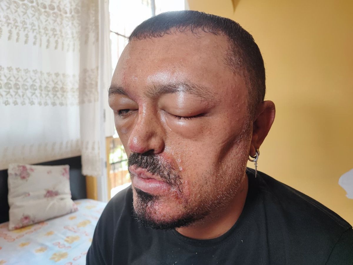 Yüzünde ve Vücutta Oluşan Alerjik Reaksiyonlar