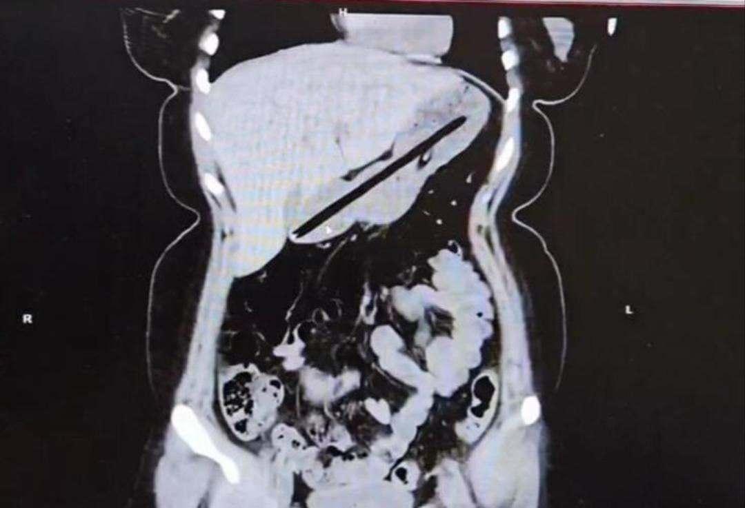 Ağrı Şikayetiyle Gelen Hasta Ameliyat Edildi: Midesinden Çıkan Şey Globe Oldu!