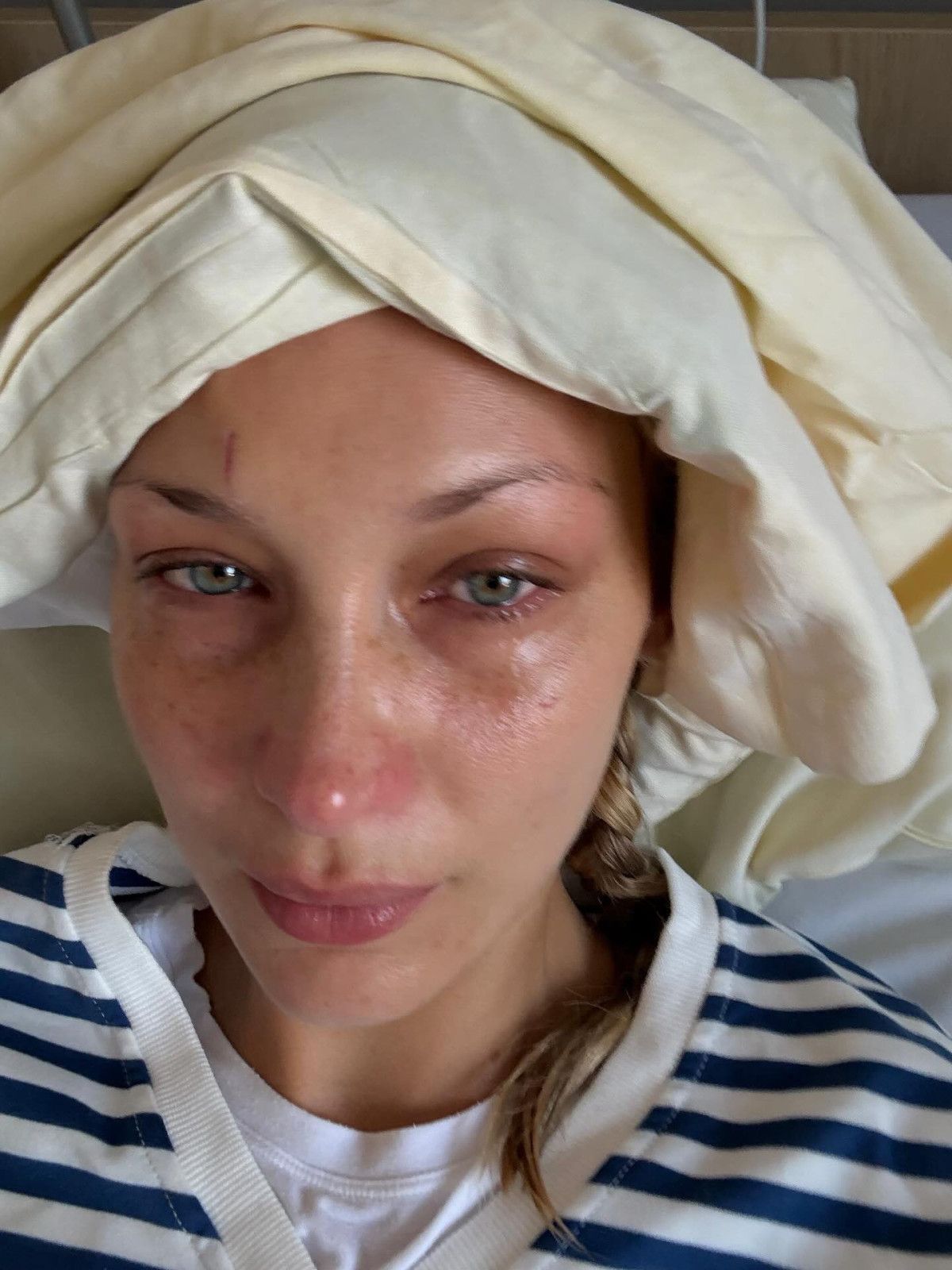 Bella Hadid'in Zor Günleri: Lyme Hastalığıyla Mücadele