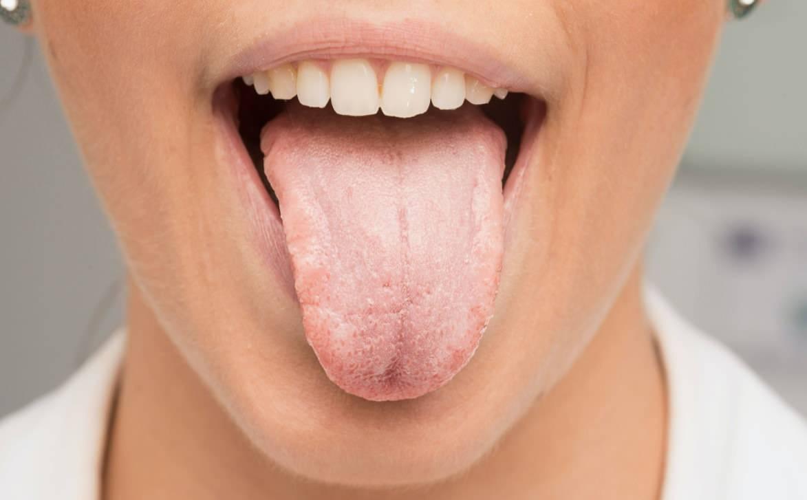 Dil Kanseri Vakalarında Artış ve Erken Teşhisin Önemi