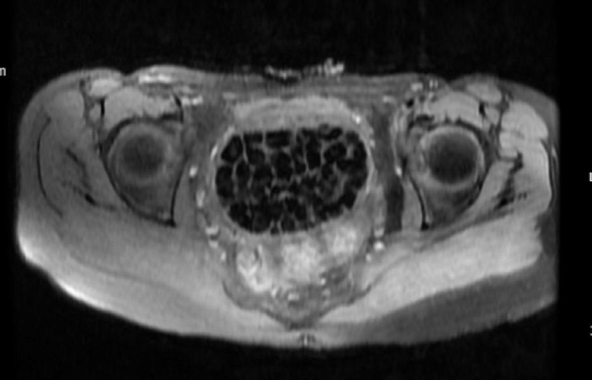 İstanbul'da Karın Ağrısıyla Giden Hasta, Vücudundan 287 Taş Çıkardı