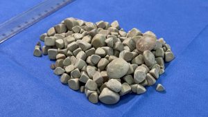 İstanbul’da Karın Ağrısıyla Giden Hasta, Vücudundan 287 Taş Çıkardı