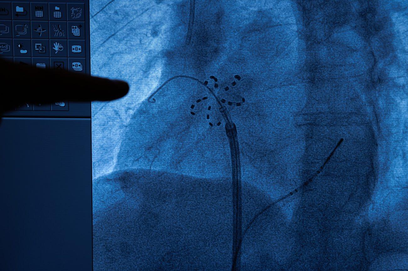 Kalpte Gizli Ritm Problemlerine Karşı Yeni ve Çığır Açan Çözüm
