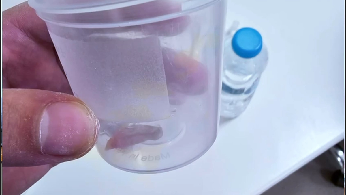 Akciğerde Gizemli Yabancı Cisim Belirlendi