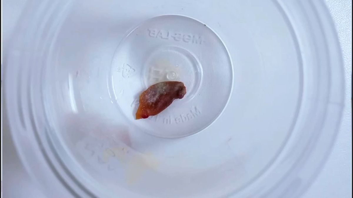 Akciğerde Gizemli Yabancı Cisim Belirlendi