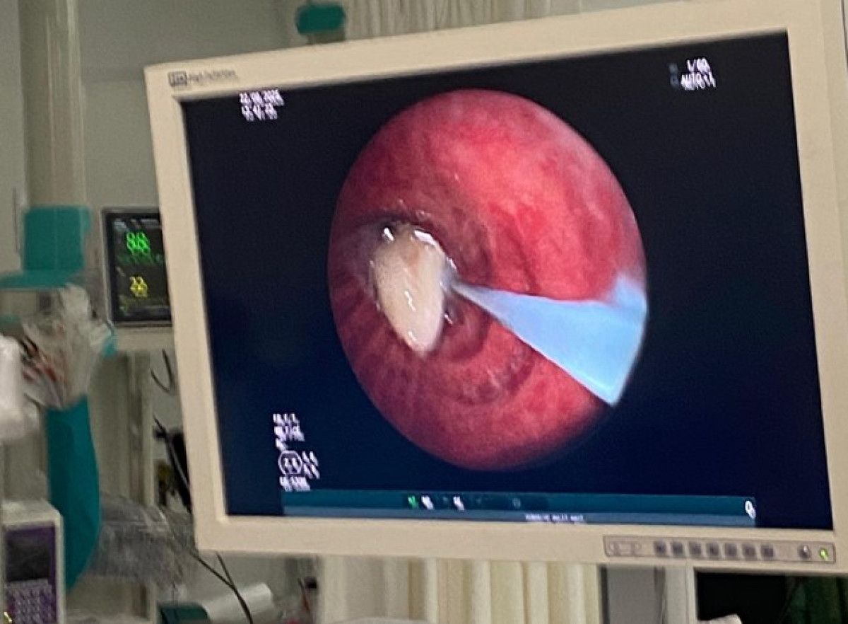 Osmaniye'de Akciğere Kaçan Sarımsağın Operasyonla Çıkarılması