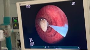 Osmaniye’de Akciğere Kaçan Sarımsağın Operasyonla Çıkarılması