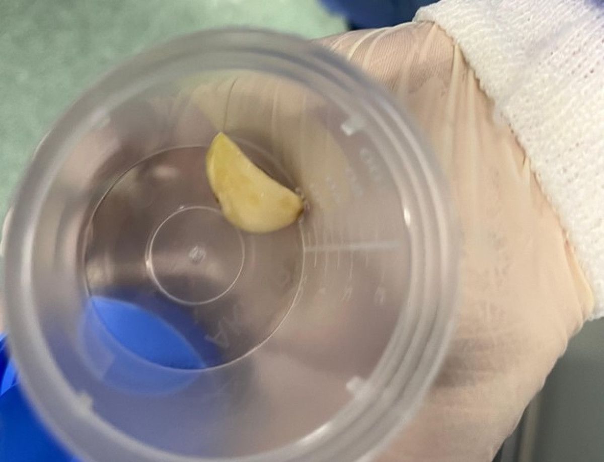 Osmaniye'de Akciğere Kaçan Sarımsağın Operasyonla Çıkarılması