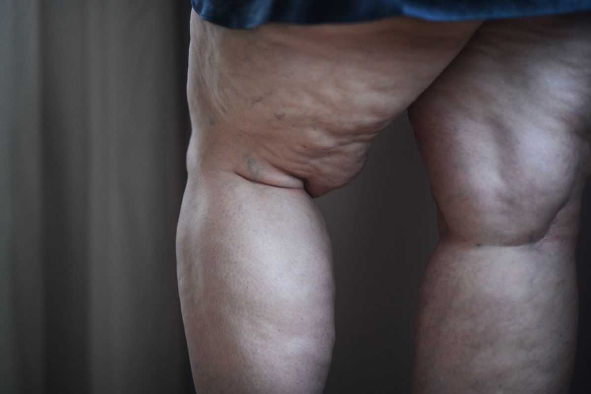 Pedikür Yaptırırken Dikkat! Damar Hastalıklarına Yol Açabilir