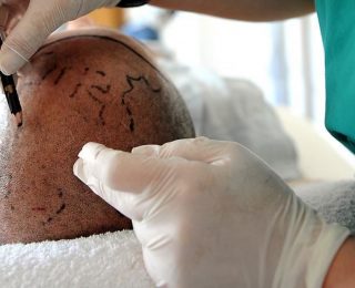 Saç Ekimi İçin Güncel Kurallar ve Yenilikler