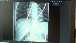 Şırnak’ta Salatalık Yutan Kişi Rahatsızlandı: Üç Yıl Önce Unutulmuş Kateter Durumu Gün yüzüne Çıktı