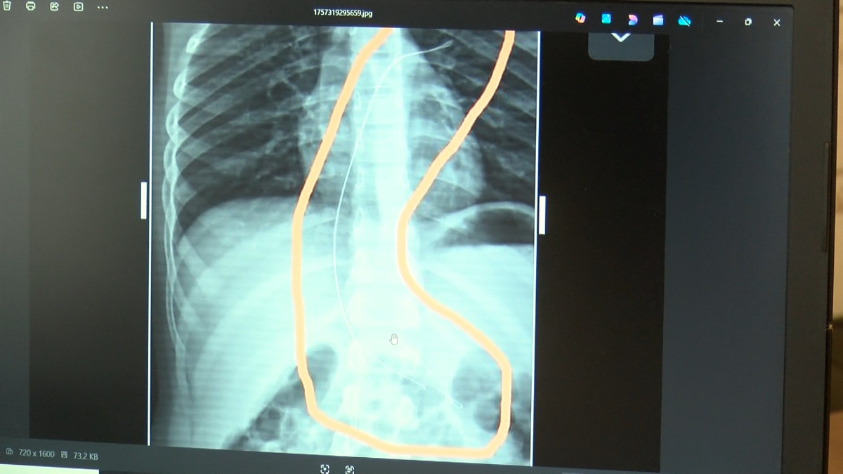 Kateterin Ameliyatla Çıkarılması ve Sonuçları