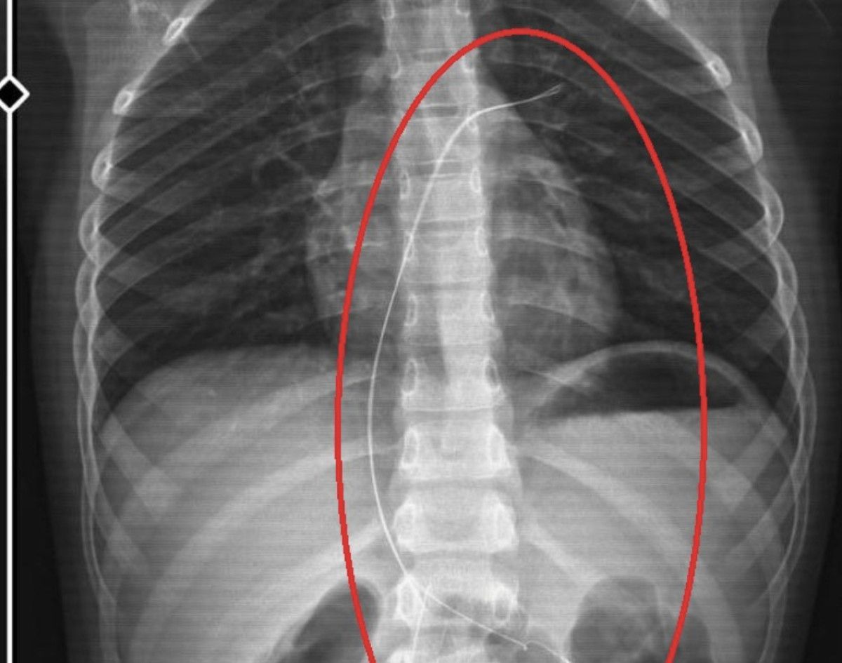 Çocukta Kalıcı Hasar ve Güncel Durumu