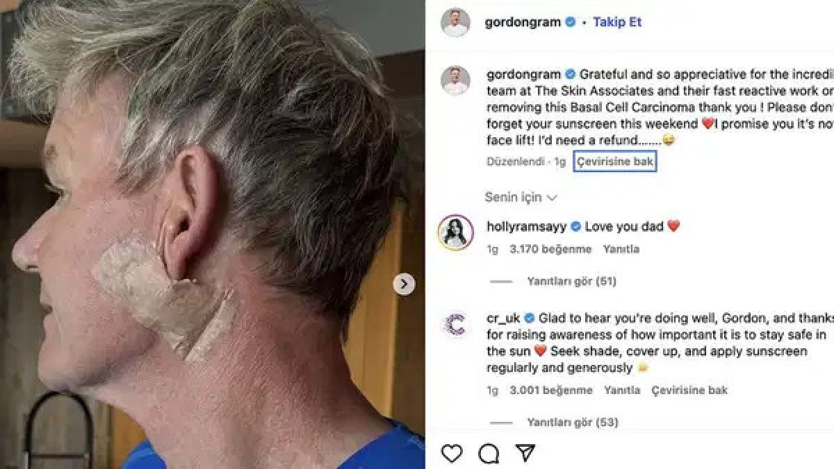 Ünlü Şef Gordon Ramsay'nin Cilt Kanseri Teşhisi ve Detayları