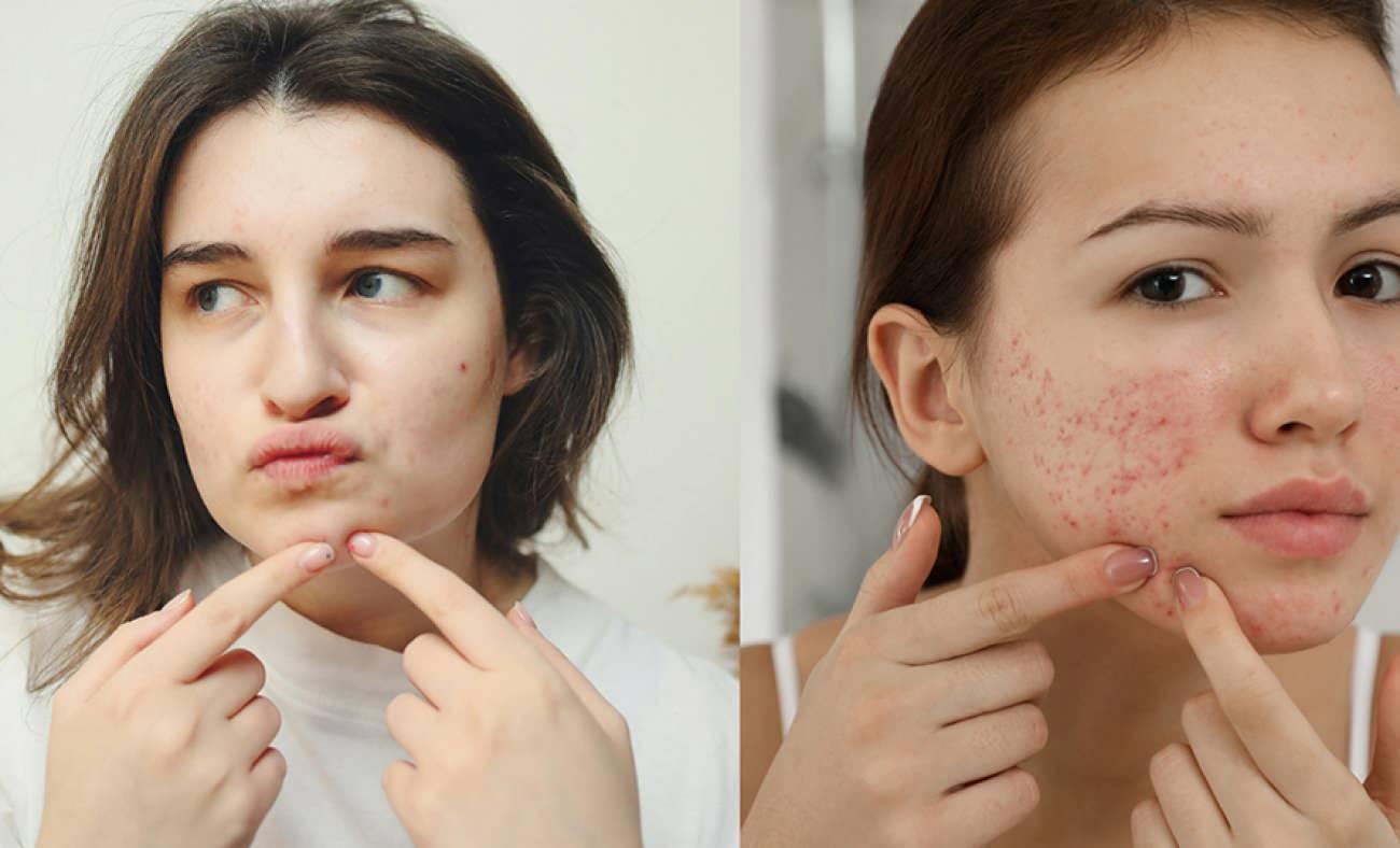 Akne İzi Türleri ve Güncel Tedavi Yöntemleri