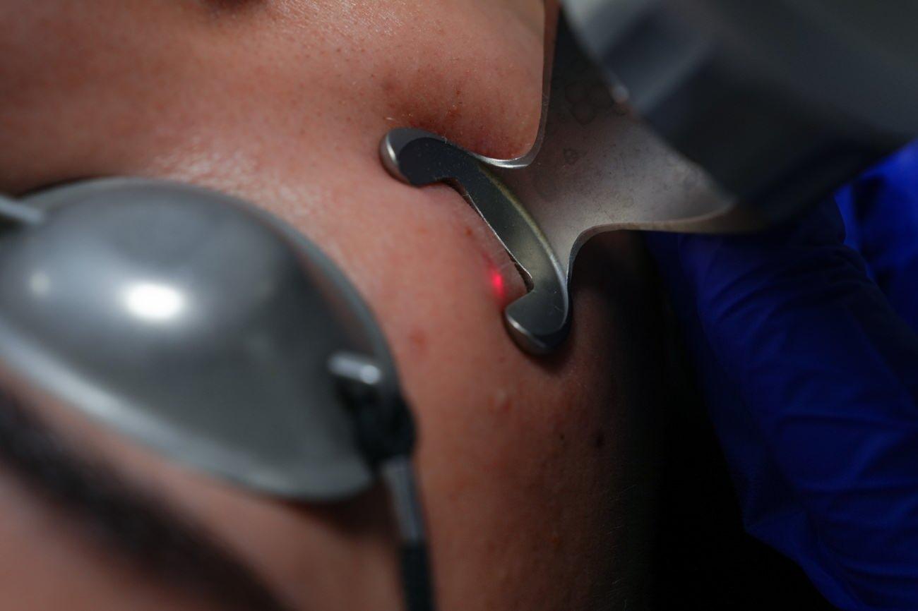 Uzmanlardan Uyarı: Akne İzlerinde Erken ve Doğru Müdahale ile Güzelliğinize Kavuşun