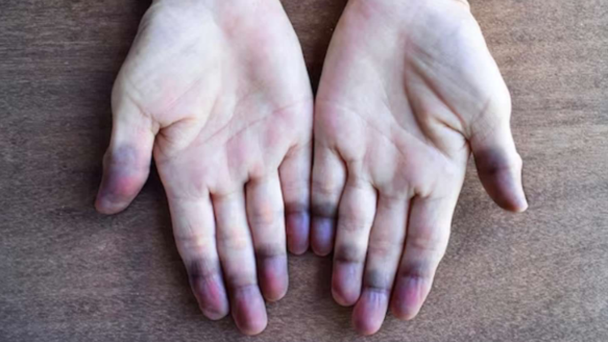 Hastalığın Belirtileri ve Gelişimi