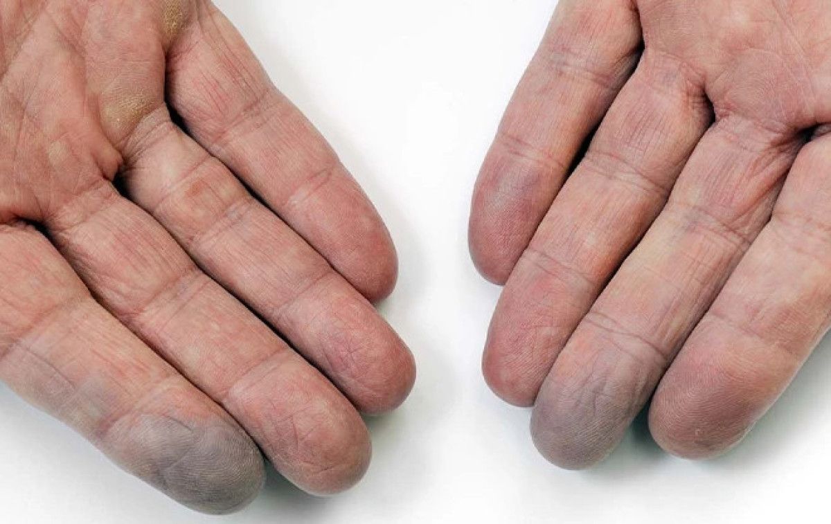 Erken Tanı ve Tedavi Yöntemleri